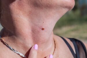 Woman pointing to cancerous mole on her neck, who may be candidate for Mohs surgery