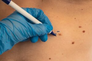 Doctor marking a male patient's skin before Mohs surgery, preparing for skin cancer removal and melanoma prevention.