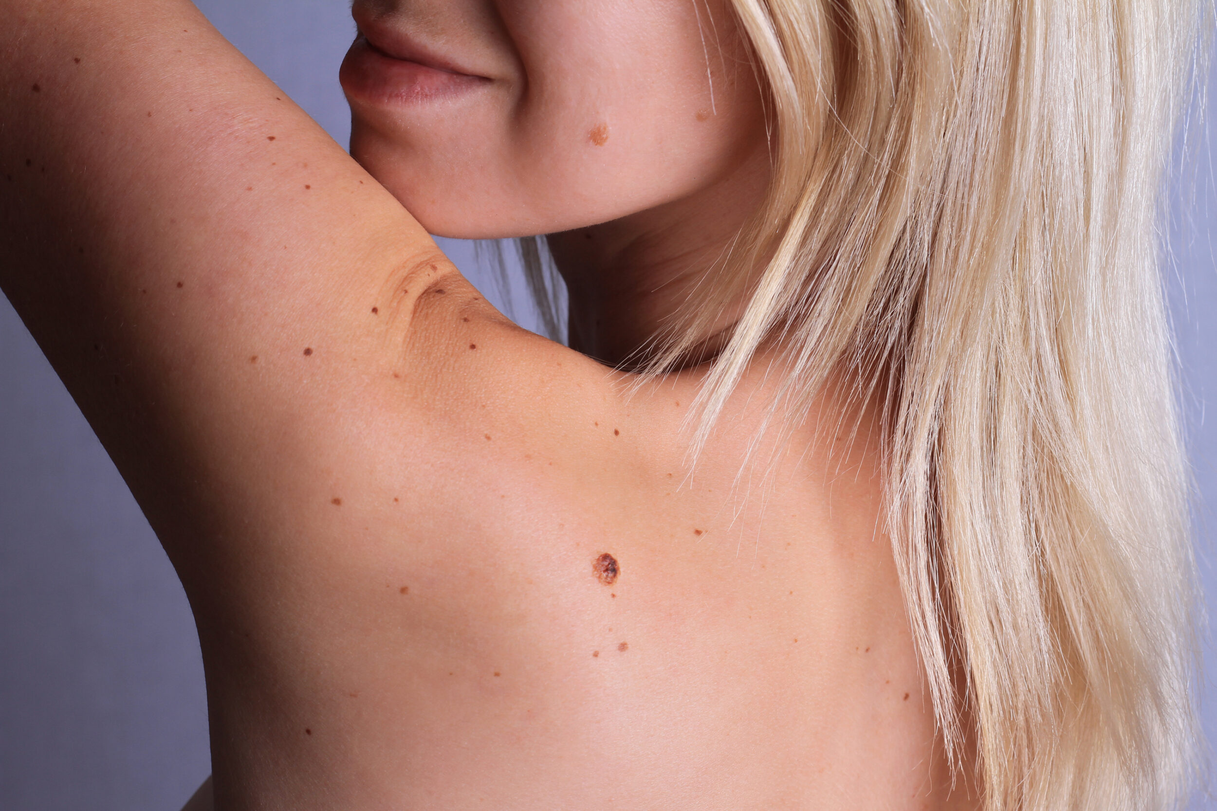 Woman's back has a mole that a doctor will examine for safety