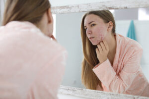 Woman examines her unmanaged acne breakout on her face in a bathroom mirror.
