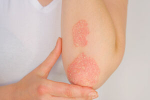 Psoriasis is visible on a patient's elbow