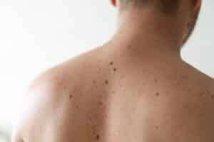 Checking,Benign,Moles.,Close,Up,Detail,Of,The,Bare,Skin Mohs Micrographic Treatment Charleston WV