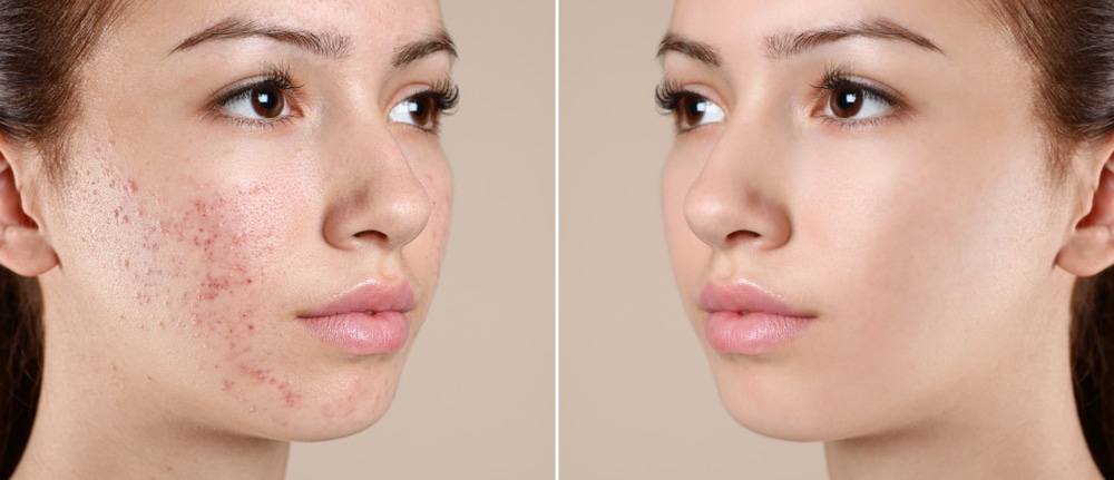 Before & After Acne Treatment Charleston WV
