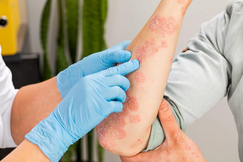 A,Dermatologist,Wearing,Gloves,Examines,The,Skin,Of,A,Sick Doctor examines patient's arm with psoriasis