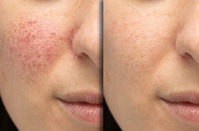 Before and after photos of the cheek of a woman who has rosacea.